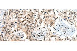 Immunohistochemistry of paraffin-embedded Human lung cancer tissue using CDKL2 Polyclonal Antibody at dilution of 1:25(x200)
