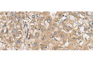 Immunohistochemistry of paraffin-embedded Human liver cancer tissue using PAPSS2 Polyclonal Antibody at dilution of 1:60(x200) (PAPSS2 antibody)