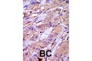 Formalin-fixed and paraffin-embedded human cancer tissue reacted with CSNK1E polyclonal antibody  , which was peroxidase-conjugated to the secondary antibody, followed by DAB staining. (CK1 epsilon antibody  (C-Term))