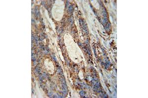 FA antibody (Center) (ABIN654352 and ABIN2844119) immunohistochemistry analysis in formalin fixed and paraffin embedded human colon carcinoma followed by peroxidase conjugation of the secondary antibody and DAB staining. (FAM46A antibody  (AA 89-117))