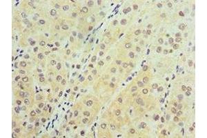 Immunohistochemistry of paraffin-embedded human liver cancer using ABIN7143632 at dilution of 1:100 (AARS2 antibody  (AA 841-985))