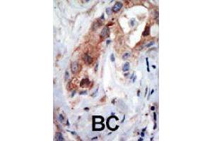 Formalin-fixed and paraffin-embedded human cancer tissue reacted with PIP5K1B polyclonal antibody  , which was peroxidase-conjugated to the secondary antibody, followed by AEC staining. (PIP5K1B antibody  (N-Term))