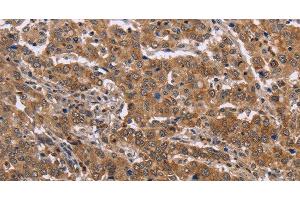 Immunohistochemistry of paraffin-embedded Human liver cancer tissue using FAAH2 Polyclonal Antibody at dilution 1:30 (FAAH2 antibody)