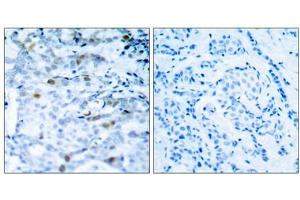 Immunohistochemical analysis of paraffin-embedded human breast carcinoma tissue using CDC2(Phospho-Thr161) Antibody(left) or the same antibody preincubated with blocking peptide(right). (CDK1 antibody  (pThr161))