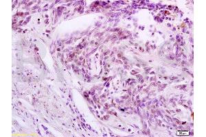 Formalin-fixed and paraffin embedded human rectal carcinoma labeled with Anti-Phospho-cdc25C (Thr48) Polyclonal Antibody, Unconjugated (ABIN746993) at 1:200 followed by conjugation to the secondary antibody and DAB (CDC25C antibody  (pThr48))