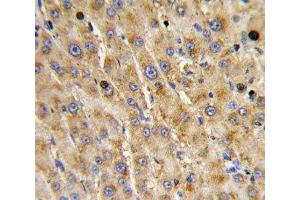 IHC analysis of FFPE human hepatocarcinoma with ADAMTS13 antibody