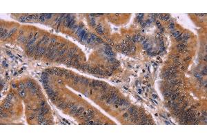 Immunohistochemistry of paraffin-embedded Human colon cancer tissue using CDC5L Polyclonal Antibody at dilution 1:40 (CDC5L antibody)