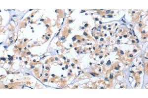 Immunohistochemistry of paraffin-embedded Human thyroid cancer tissue using EDN3 Polyclonal Antibody at dilution 1:30 (Endothelin 3 antibody)