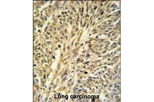 IDH2 Antibody (Center) (ABIN391584 and ABIN2841516) IHC analysis in formalin fixed and paraffin embedded human Lung carcinoma followed by peroxidase conjugation of the secondary antibody and DAB staining. (IMPDH2 antibody  (AA 180-210))