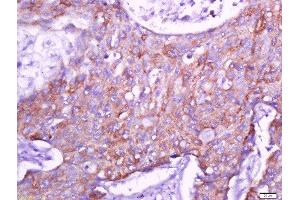 Paraformaldehyde-fixed, paraffin embedded human lung carcinoma tissue, Antigen retrieval by boiling in sodium citrate buffer(pH6) for 15min, Block endogenous peroxidase by 3% hydrogen peroxide for 30 minutes, Blocking buffer (normal goat serum) at 37°C for 20min, Antibody incubation with Rabbit Anti-Connexin 40 Polyclonal Antibody, Unconjugated  at 1:500 overnight at 4°C, followed by a conjugated secondary and DAB staining (Cx40/GJA5 antibody  (AA 301-358))