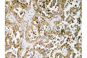 Immunohistochemical analysis of paraffin-embedded human lung cancer tissue using OR4D1 polyclonal antibody .