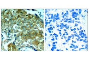 Immunohistochemical analysis of paraffin-embedded human breast carcinoma tissue using EGFR(Phospho-Tyr1172) Antibody(left) or the same antibody preincubated with blocking peptide(right).