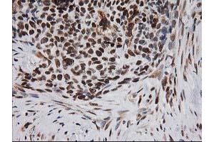 Immunohistochemical staining of paraffin-embedded Adenocarcinoma of Human breast tissue using anti-ERCC4 mouse monoclonal antibody.