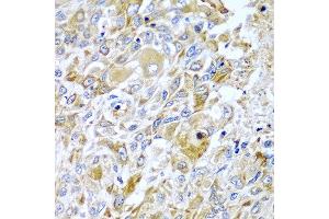 Immunohistochemistry of paraffin-embedded human lung cancer using HAVCR2 antibody at dilution of 1:100 (x40 lens). (TIM3 antibody)