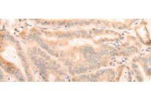 Immunohistochemistry of paraffin-embedded Human thyroid cancer tissue using ELP4 Polyclonal Antibody at dilution of 1:25(x200) (ELP4 antibody)