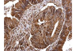 IHC-P Image Thymidylate synthetase antibody detects Thymidylate synthetase protein at cytosol and nucleus on human colon carcinoma by immunohistochemical analysis. (TYMS antibody)