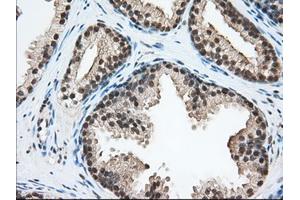 Immunohistochemical staining of paraffin-embedded Adenocarcinoma of Human ovary tissue using anti-ERCC1 mouse monoclonal antibody.