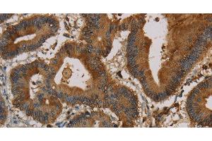 Immunohistochemistry of paraffin-embedded Human colon cancer using CK-16 Polyclonal Antibody at dilution of 1:30 (KRT16 antibody)