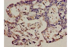 Immunohistochemistry analysis of human pancreatic cancer using ABIN7171289 at dilution of 1:100 (TCRb antibody  (AA 22-115))