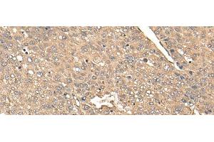 Immunohistochemistry of paraffin-embedded Human liver cancer tissue using BDH2 Polyclonal Antibody at dilution of 1:65(x200) (BDH2 antibody)