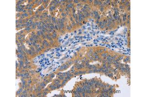 Immunohistochemistry of Human cervical cancer using NBEA Polyclonal Antibody at dilution of 1:60 (Neurobeachin antibody)