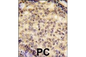 Formalin-fixed and paraffin-embedded human prostata carcinoma tissue reacted with SOX9 antibody (N-term) (ABIN388162 and ABIN2846958) , which was peroxidase-conjugated to the secondary antibody, followed by DAB staining. (SOX9 antibody  (N-Term))