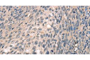 Immunohistochemistry of paraffin-embedded Human cervical cancer tissue using CDK12 Polyclonal Antibody at dilution 1:30 (CDK12 antibody)