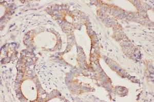 Immunohistochemistry (IHC) image for anti-Fatty Acid Binding Protein 5 (Psoriasis-Associated) (FABP5) (AA 2-16), (N-Term) antibody (ABIN3043194)