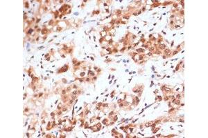 Immunohistochemistry of paraffin-embedded Human liver cancer using Phospho-STAT1(S727) Polyclonal Antibody at dilution of 1:100 (40x lens). (STAT1 antibody  (pSer727))