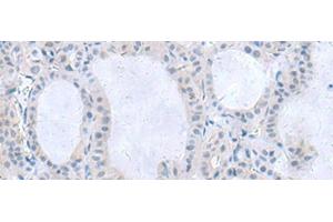 Immunohistochemistry of paraffin-embedded Human thyroid cancer tissue using IL1B Polyclonal Antibody at dilution of 1:55(x200) (IL-1 beta antibody)
