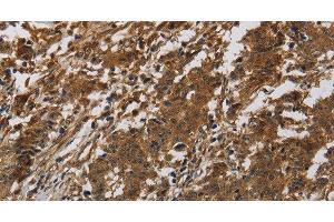 Immunohistochemistry of paraffin-embedded Human liver cancer tissue using ITGB7 Polyclonal Antibody at dilution of 1:40 (Integrin beta 7 antibody)