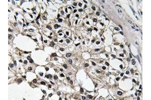 Immunohistochemistry analyzes of IRS-1 antibody in paraffin-embedded human breast carcinoma tissue. (IRS1 antibody)