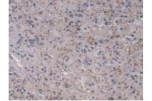 Detection of UBE2L3 in Human Glioma Tissue using Polyclonal Antibody to Ubiquitin Conjugating Enzyme E2L3 (UBE2L3) (UBE2L3 antibody  (AA 4-154))