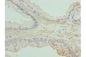 Immunohistochemistry of paraffin-embedded human prostate cancer using ABIN7143144 at dilution of 1:100 (ACTG2 antibody  (AA 181-376))