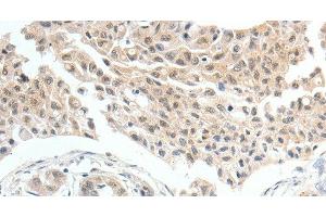 Immunohistochemistry of paraffin-embedded Human lung cancer tissue using MDK Polyclonal Antibody at dilution 1:60 (Midkine antibody)
