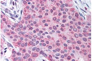 Human Breast Carcinoma (formalin-fixed, paraffin-embedded) stained with MMP13 antibody ABIN290538 at 50 ug/ml followed by biotinylated goat anti-rabbit IgG secondary antibody ABIN481713, alkaline phosphatase-streptavidin and chromogen. (MMP13 antibody  (C-Term))