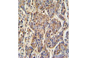 Formalin-fixed and paraffin-embedded human hepatocarcinoma with CATB Antibody (Center), which was peroxidase-conjugated to the secondary antibody, followed by DAB staining. (Tyrosinase-Related Protein 1 antibody  (AA 198-227))