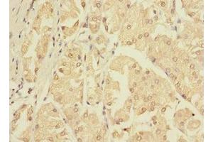 Immunohistochemistry of paraffin-embedded human gastric cancer using ABIN7176445 at dilution of 1:100 (ZNF624 antibody  (AA 127-327))
