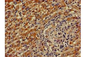 Immunohistochemistry of paraffin-embedded human liver cancer using ABIN7148816 at dilution of 1:100 (CREB3L1 antibody  (AA 396-500))