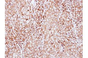 IHC-P Image Immunohistochemical analysis of paraffin-embedded A549 xenograft, using MMP3, antibody at 1:500 dilution. (MMP3 antibody)