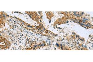 Immunohistochemistry of paraffin-embedded Human cervical cancer tissue using TUBD1 Polyclonal Antibody at dilution of 1:70(x200)