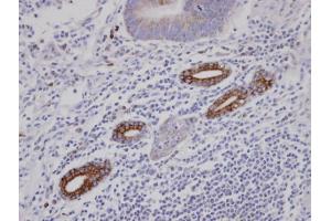 IHC-P Image Immunohistochemical analysis of paraffin-embedded human gastric cancer, using AKAP10, antibody at 1:100 dilution. (AKAP10 antibody  (C-Term))