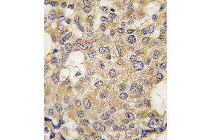 Formalin-fixed and paraffin-embedded human breast carcinoma tissue reacted with Parg antibody (C-term) (ABIN391439 and ABIN2841426) , which was peroxidase-conjugated to the secondary antibody, followed by DAB staining. (PARG antibody  (C-Term))
