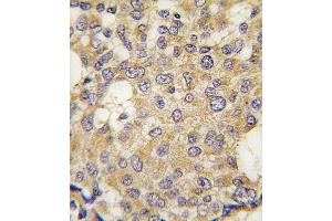 Formalin-fixed and paraffin-embedded human breast carcinoma tissue reacted with Parg antibody (C-term) (ABIN391439 and ABIN2841426) , which was peroxidase-conjugated to the secondary antibody, followed by DAB staining. (PARG antibody  (C-Term))