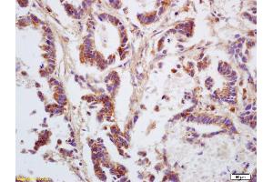 Formalin-fixed and paraffin embedded human gastric carcinoma labeled with Anti GNA12/G protein alpha 12 Polyclonal Antibody, Unconjugated (ABIN753958) at 1:200 followed by conjugation to the secondary antibody and DAB staining (GNA12 antibody  (AA 301-381))