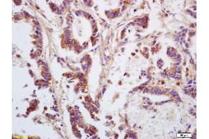 Formalin-fixed and paraffin embedded human gastric carcinoma labeled with Anti GNA12/G protein alpha 12 Polyclonal Antibody, Unconjugated (ABIN753958) at 1:200 followed by conjugation to the secondary antibody and DAB staining