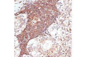 Immunohistochemistry of paraffin-embedded human liver cancer using G3BP1 antibody (ABIN7267528) at dilution of 1:100 (40x lens). (G3BP1 antibody  (AA 131-330))