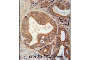 CSGALNACT1 Antibody (Center) (ABIN651115 and ABIN2840081) immunohistochemistry analysis in formalin fixed and paraffin embedded human prostate carcinoma followed by peroxidase conjugation of the secondary antibody and DAB staining. (CSGALNACT1 antibody  (AA 192-220))