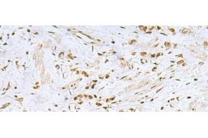 Immunohistochemistry of paraffin-embedded Human gastric cancer tissue using FOXQ1 Polyclonal Antibody at dilution of 1:25(x200) (FOXQ1 antibody)