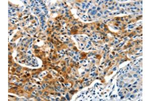 The image on the left is immunohistochemistry of paraffin-embedded Human lung cancer tissue using ABIN7190321(COG1 Antibody) at dilution 1/60, on the right is treated with synthetic peptide. (COG1 antibody)